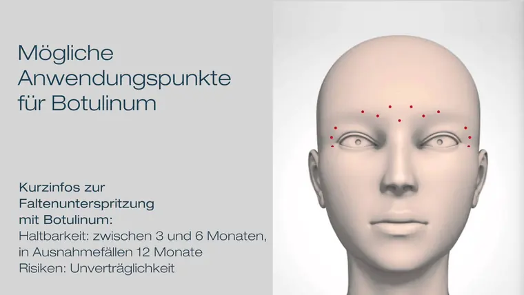 Vorschaubild zum Video über die Behandlung von Gesichtsfalten mit Botox